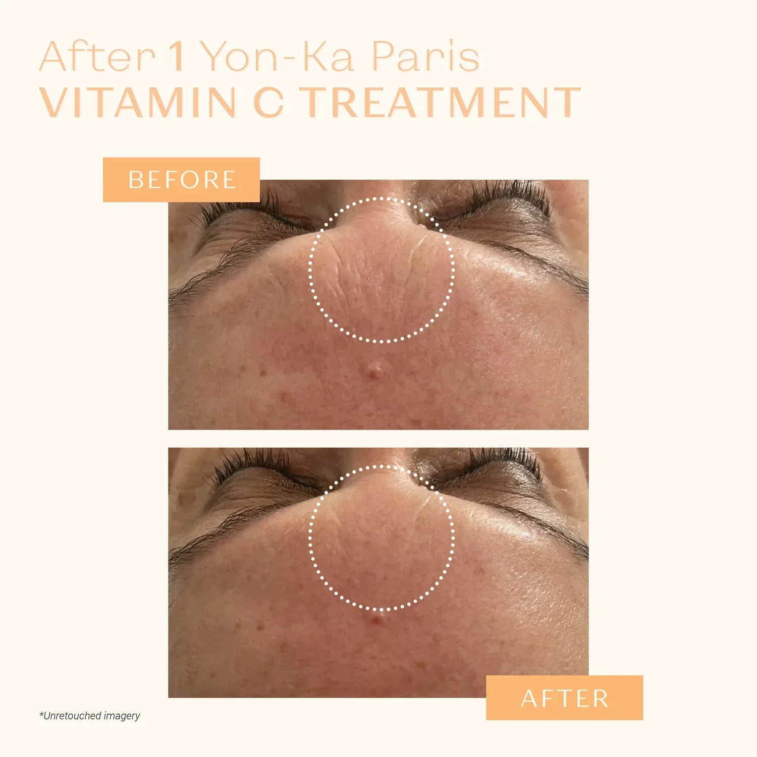 A dropper applying vitamin C serum onto a glowing skin background, highlighting its brightening and collagen-boosting benefits.